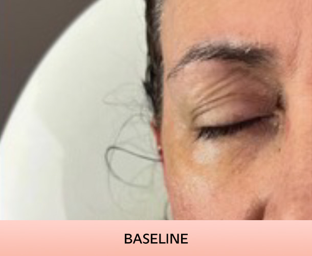 eyelid-baseline-1