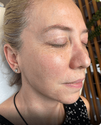 smoothglo treatment before and after