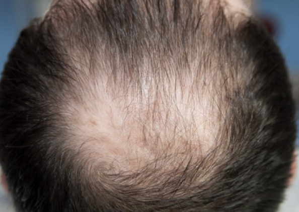 FoLix hair loss treatment before and after photos