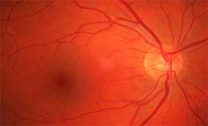 retina3 eye blood vessels with heat generated by the laser beam