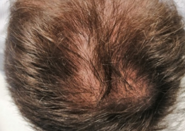 FoLix hair loss treatment before and after photos
