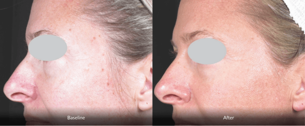 Before And After Photofabulous Treatment Before And After Photofabulous Treatment