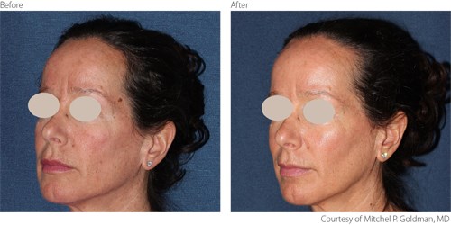 BeforeAfter4-Non-Ablative-Courtesy-of-Mitchel-P.-Goldman-M.D. Before And After Non-Ablative Treatment