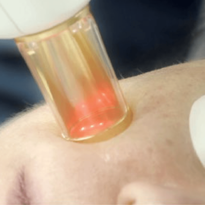 treatment_cropped treatment_cropped