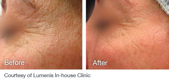 Laser Hair Removal Before And After Laser Hair Removal Before And After