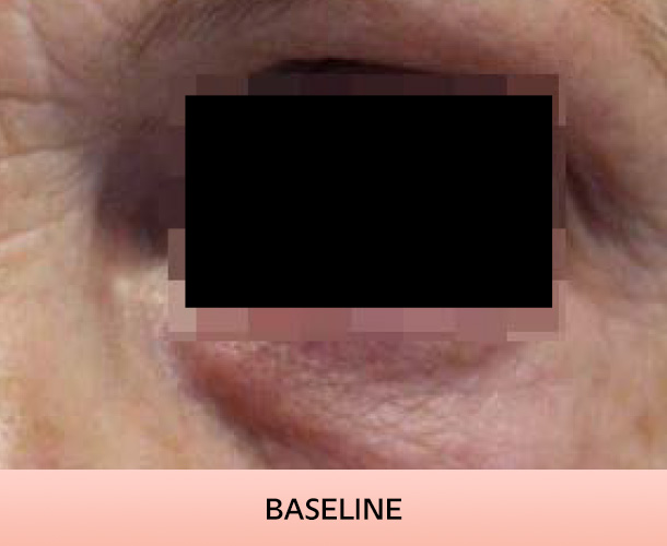 eyelid_baseline-3