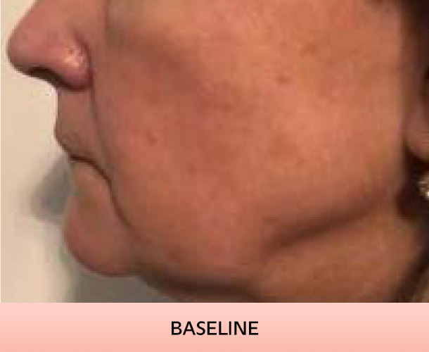 jawline_baseline-4 Jawline before triLift treatment