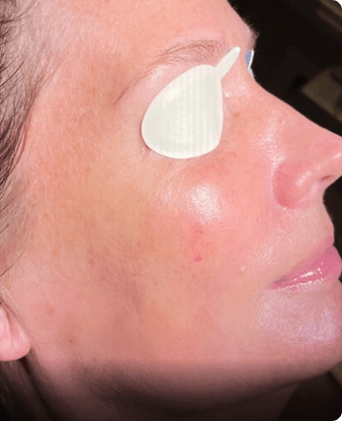 smoothglo treatment before and after