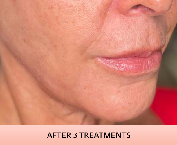jawline_after-2 Jawline after triLift treatment