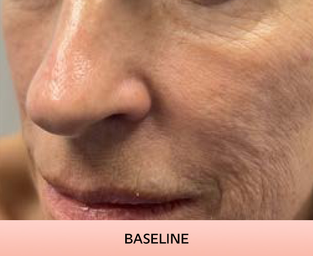 cheekbone_baseline-2 Cheekbones before triLift treatment