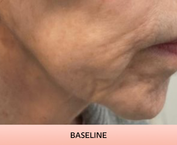 jawline_baseline-1 Jawline before triLift treatment