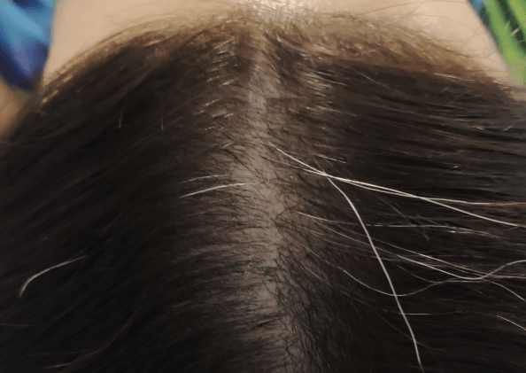 FoLix hair loss treatment before and after photos