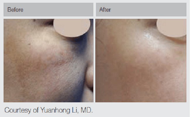 QS2_New_1 Q-Switched Nd:YAG Before And After