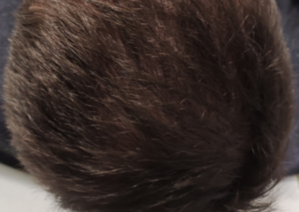 FoLix hair loss treatment before and after photos