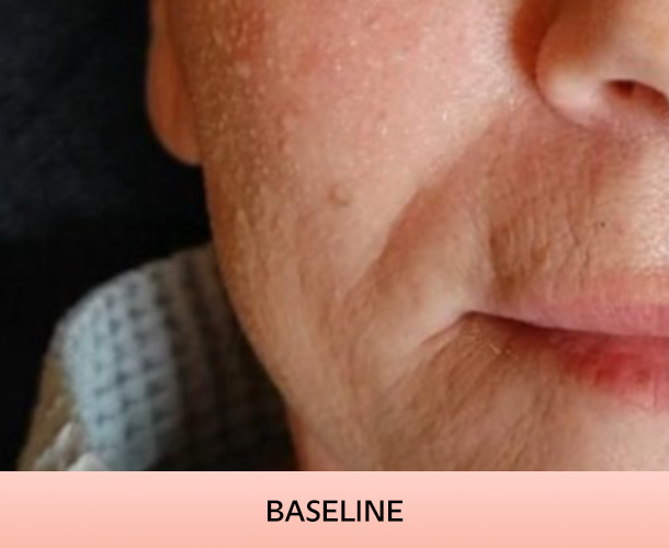 nasalfolds_baseline-1
