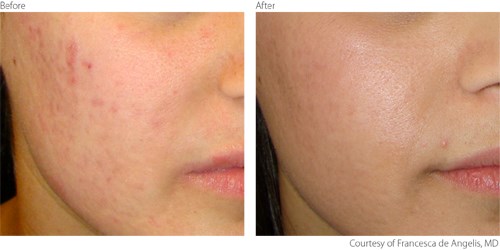 BeforeAfter1 Acne Scars Courtesy of Francesca de Angelis M.D. Before and after photos of acne scar laser revision