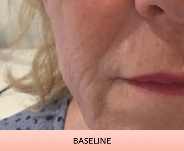 nasalfolds_baseline-2