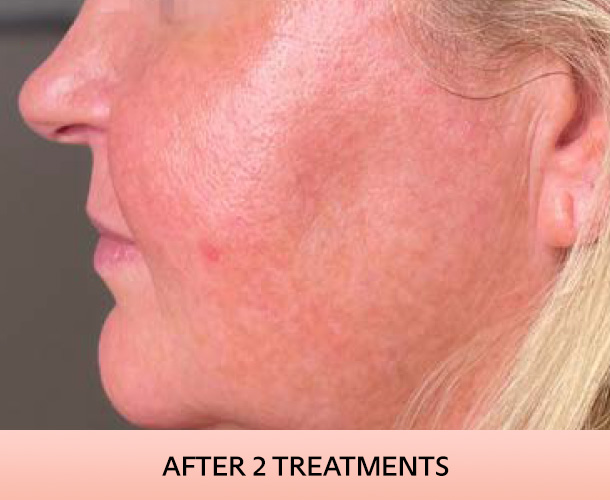 cheekbone_after-3 Cheekbones after triLift treatment