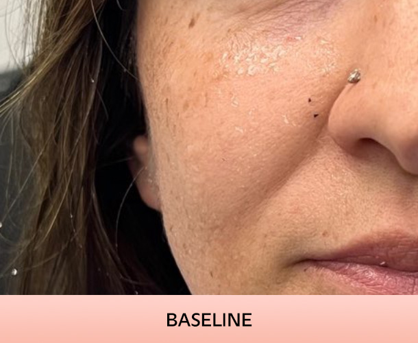 cheekbone_baseline-1 Cheekbones before triLift treatment