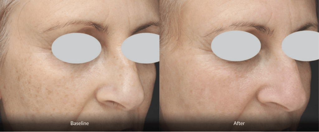 Before And After Photofabulous Treatment Before And After Photofabulous Treatment