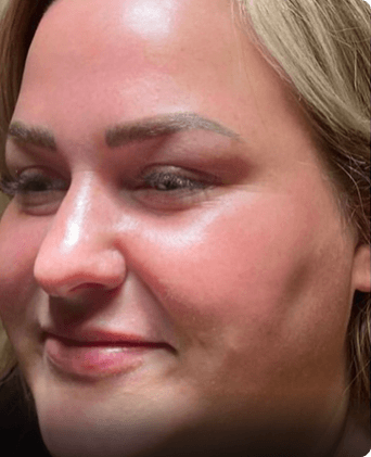 smoothglo treatment before and after