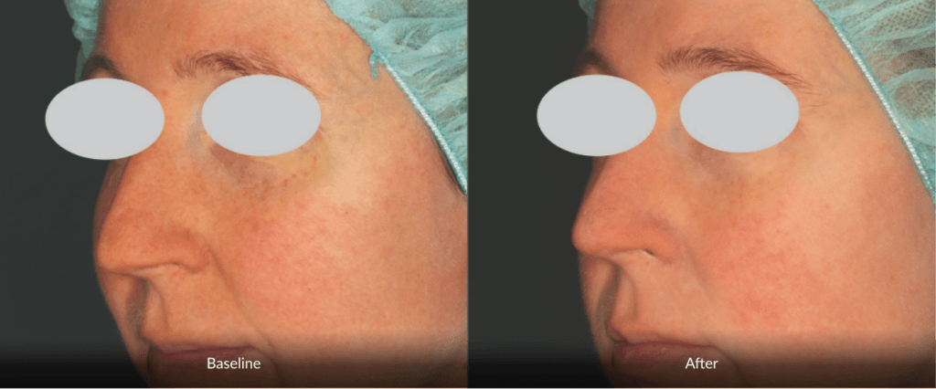 Before And After Photofabulous Treatment Before And After Photofabulous Treatment