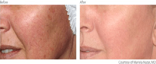 before and after Vascular Lesions treatment before and after Vascular Lesions treatment
