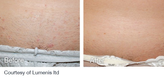 Laser Hair Removal before and after Laser Hair Removal before and after