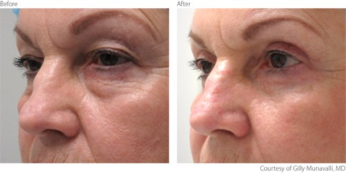 BeforeAfter2-Blepharoplasty-Courtesy-of-Gilly-Munavalli-M.D. Before And After Blepharoplasty