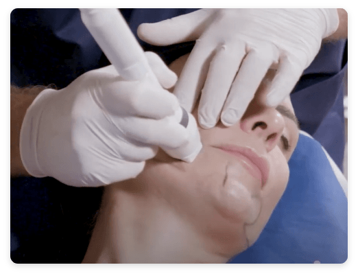 smoothglo-treatment smoothglo treatment