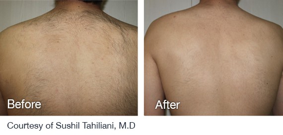 Laser Hair Removal Before And After Laser Hair Removal Before And After
