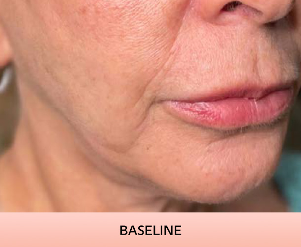jawline_baseline-2 Jawline before triLift treatment