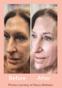 How-I-Built-my-triLift-Practice-Rondalph-Taylor-MD-Rescu-Wellness-Before-After-w815px-h1155px Before and after procedure with triLift.