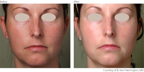 Before And After Photorejuvenation Before And After Photorejuvenation