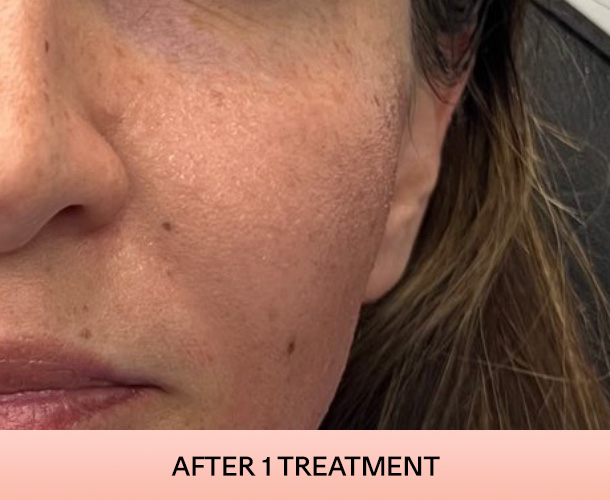 cheekbone_after-1 Cheekbones after triLift treatment