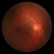 retina2 Photocoagulators cauterize eye blood vessels with heat generated by the laser beam