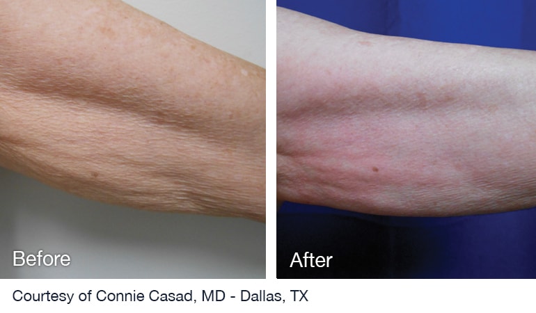 Before And After NuEra tight Skin Smoothing Treatment Before And After NuEra tight Skin Smoothing Treatment