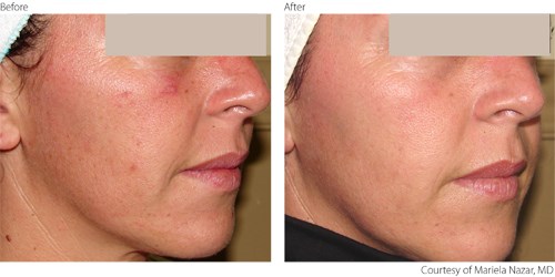 Before And After Photorejuvenation Treatment Before And After Photorejuvenation Treatment