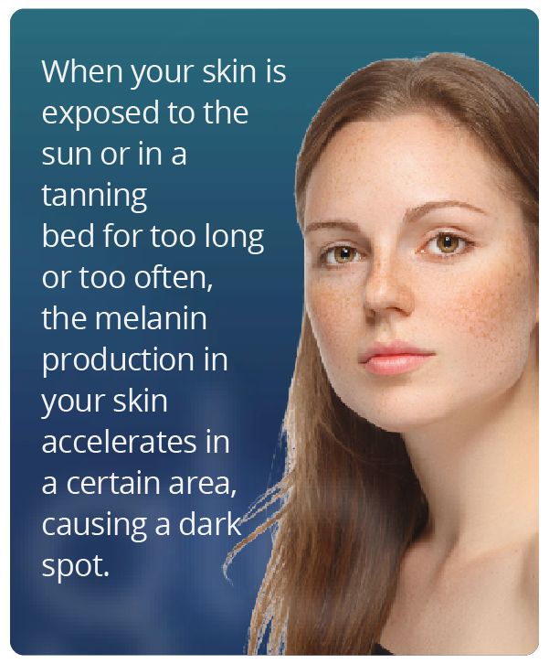 Artboard 2 How sun and a tanning bed can cause dark spots on your skin
