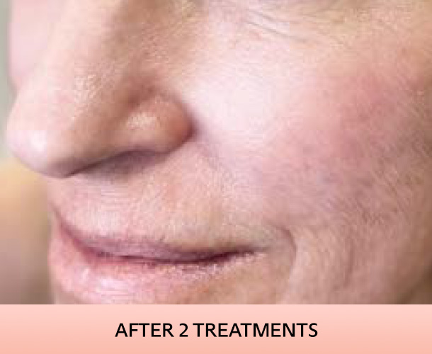 cheekbone_after-2 Cheekbones after triLift treatment