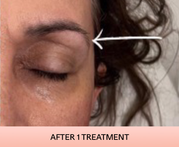 eyelid-after-1