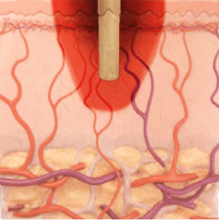 Up to 1mm in a single pulse