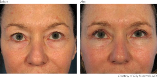 BeforeAfter1-Blepharoplasty-Courtesy-of-Gilly-Munavalli-M.D.