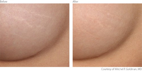 BeforeAfter 3 Non-Ablative Courtesy of Mitchel P. Goldman, M.D. Before And After Non-Ablative Treatment