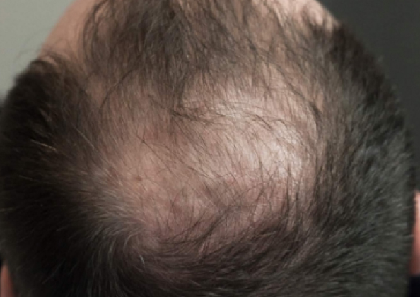 FoLix hair loss treatment before and after photos