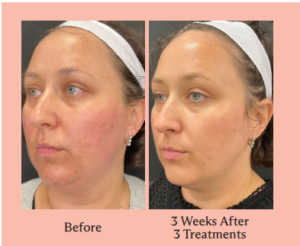 Before&After triLift Before and after photos of facelift-like procedure with triLift device.