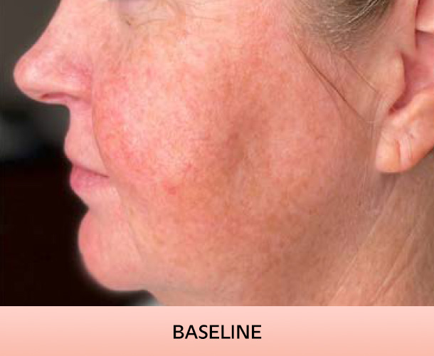 cheekbone_baseline-3 Cheekbones before triLift treatment