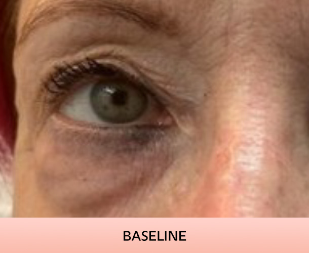 eyelid_baseline-2