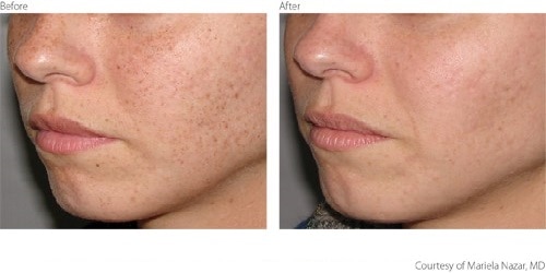 Before After Pigmentation Freckles treatment Before After Pigmentation Freckles treatment