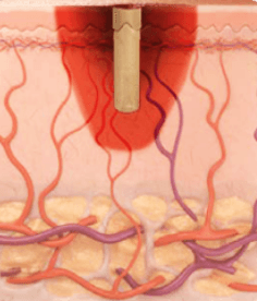 co2-continuous-wave-image2